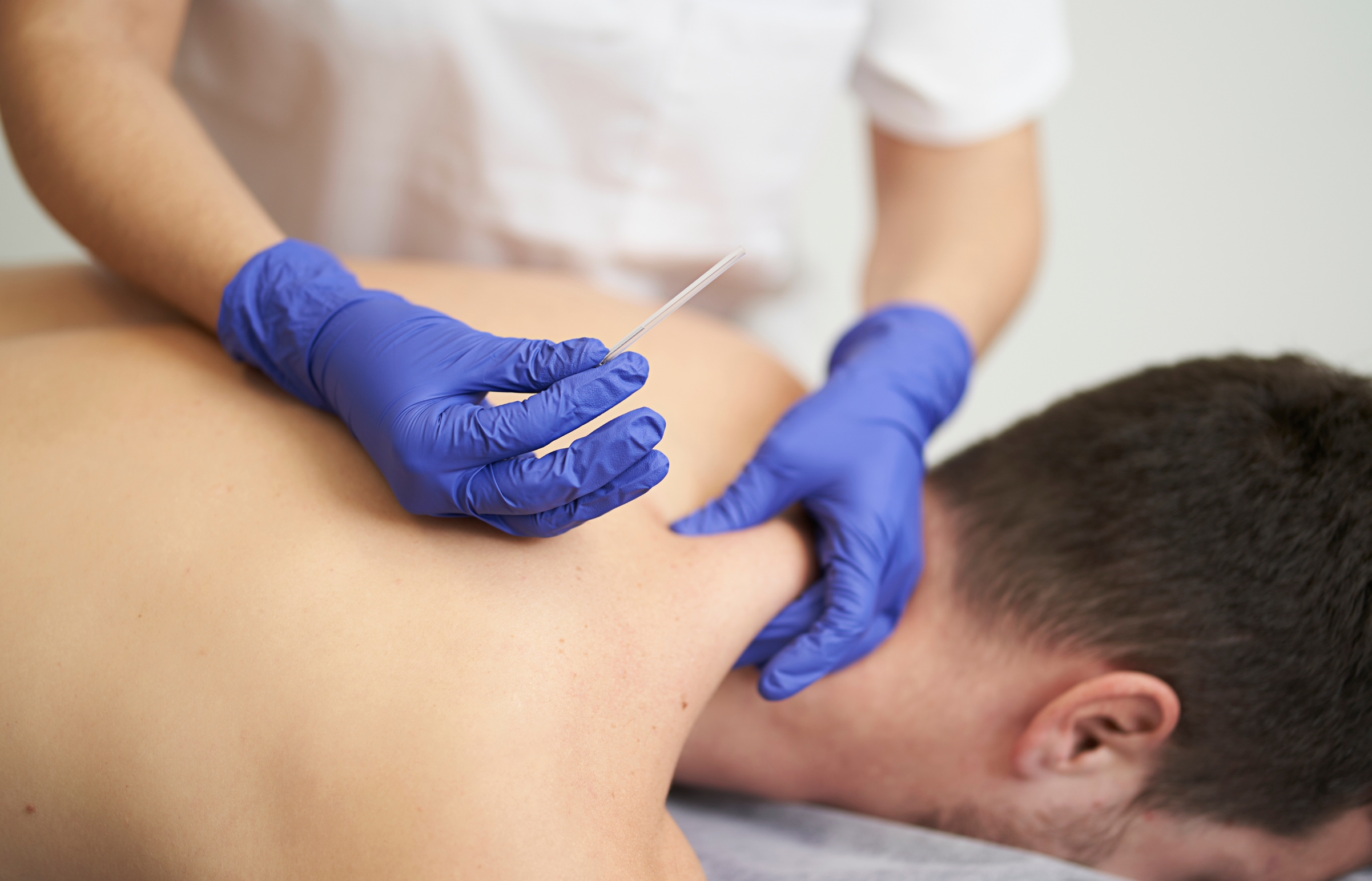 Dry needling